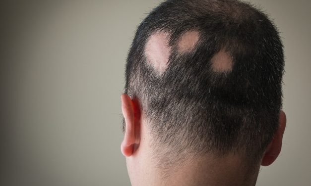 Alopecia areata: cause ed effetti